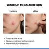 ZAP Microneedle acne patches