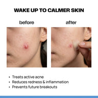 ZAP Microneedle acne patches